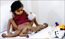 В Индия ще оперират момиченце с 4 ръце и 4 крака