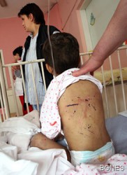2-годишно дете от Литаково прието в „Пирогов”  бито, измързнало и прегладняло  