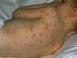 Случай на морбили в Разлив